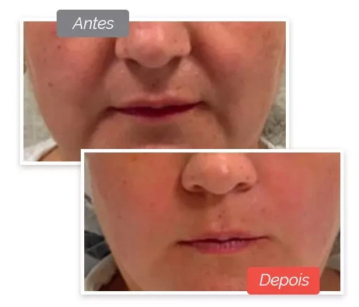 Antes e depois: Fios de Sustentação PDO